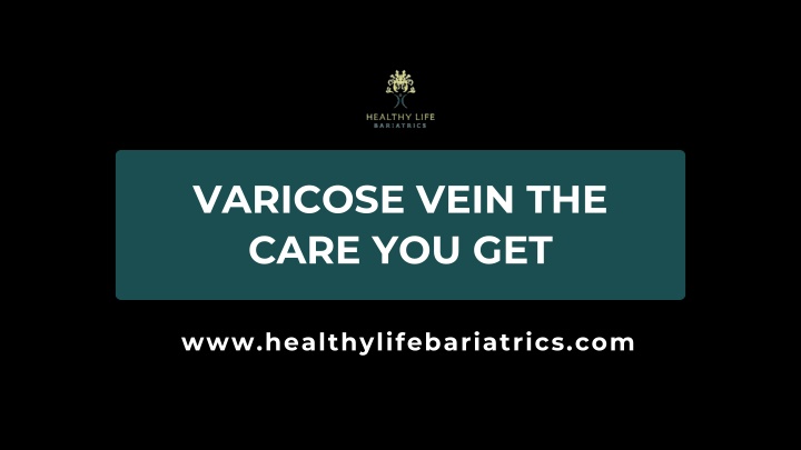 varicose vein the care you get n.w