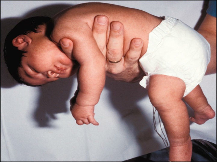 Hypotonia in Infants: Causes, Evaluation, and Management