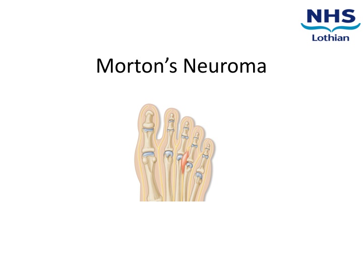 Morton's Neuroma: Causes, Symptoms, and Management