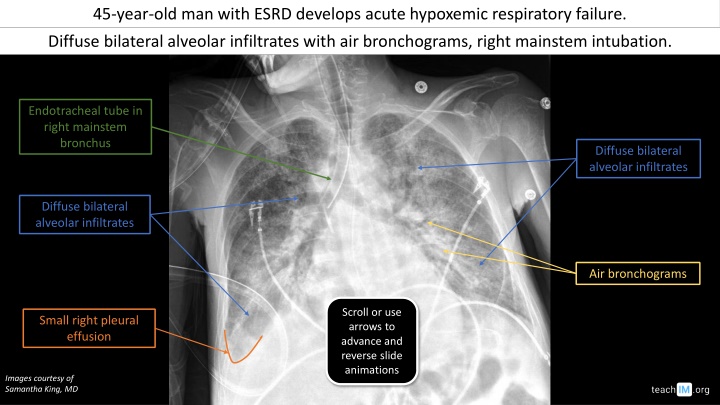 Acute Respiratory Failure in ESRD Patients with Diffuse Bilateral Alveolar Infiltrates