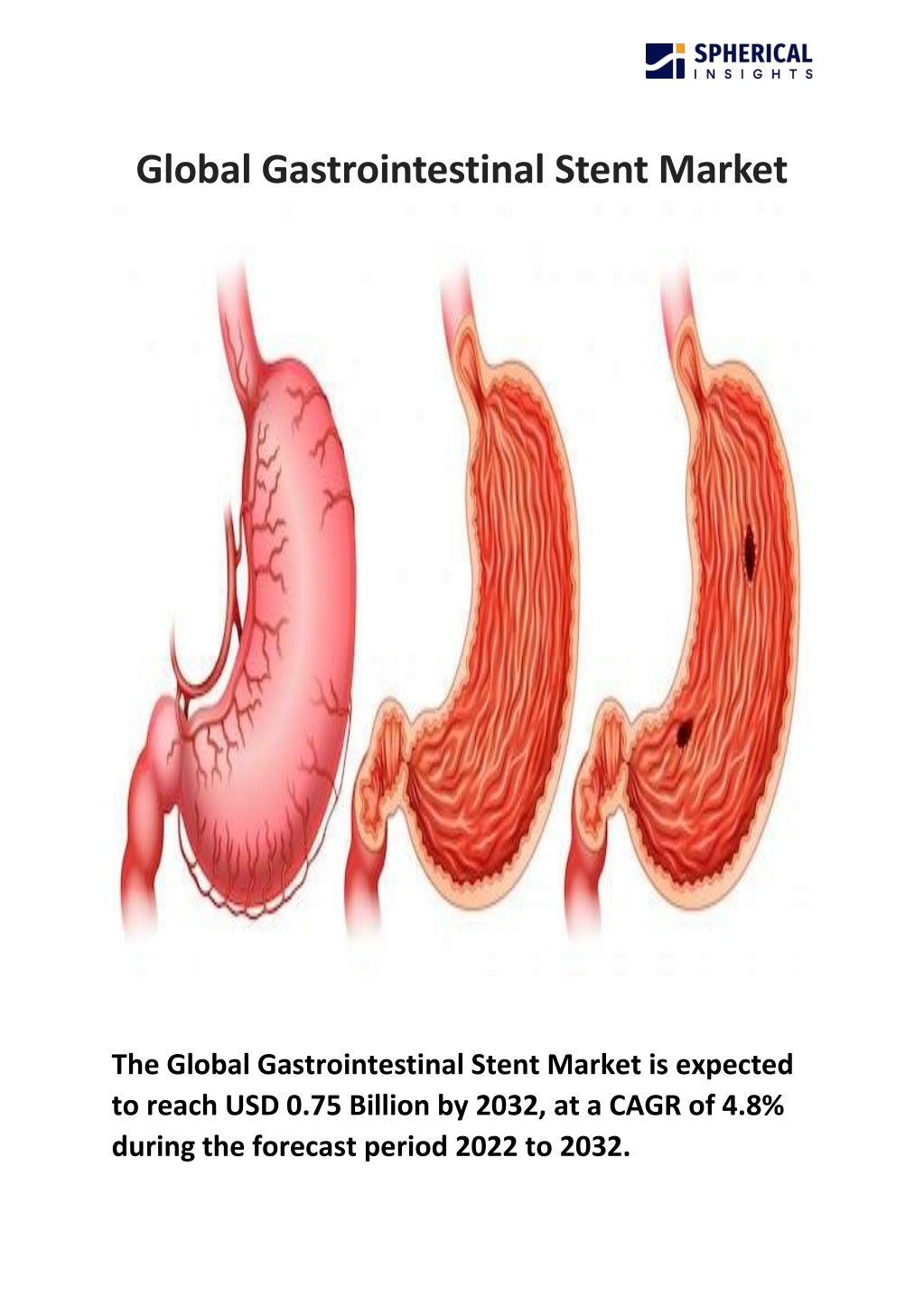 global gastrointestinal stent market l.w