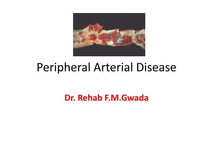 Peripheral Arterial Disease (PAD) - Overview and Management