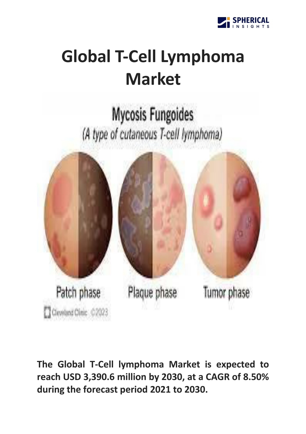 global t cell lymphoma market l.w