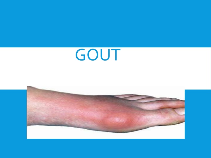Gout: Causes, Symptoms, and Management
