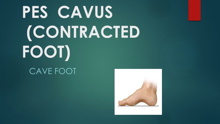 Pes Cavus: Causes, Symptoms, and Treatment Options