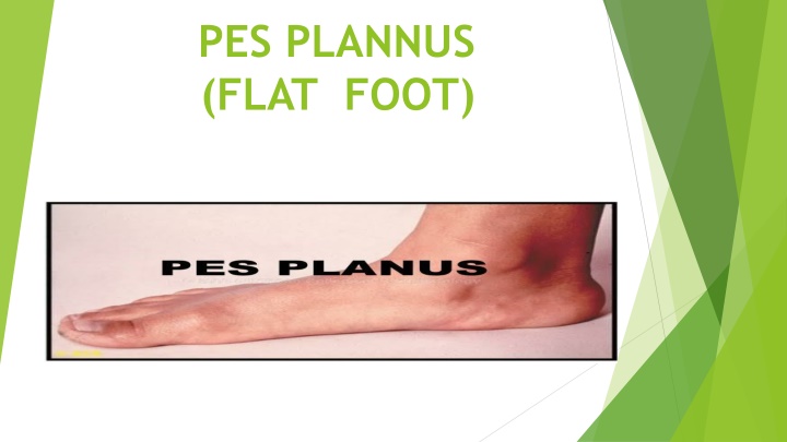 Pes Planus (Flat Foot) and its Management