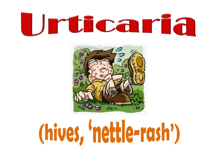 Urticaria: Causes, Types, and Management