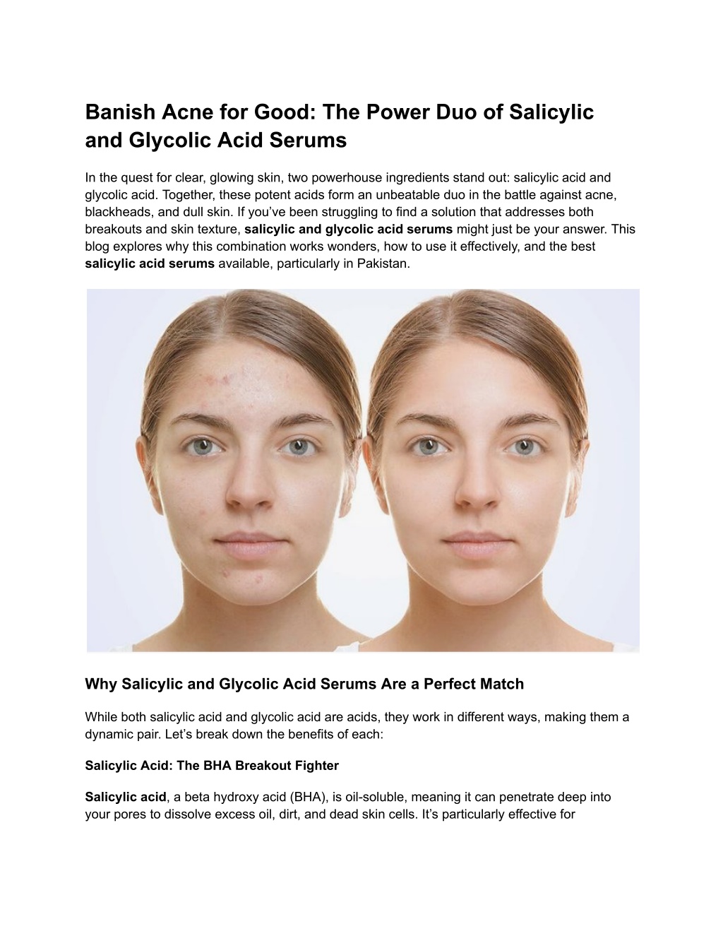 banish acne for good the power duo of salicylic l.w