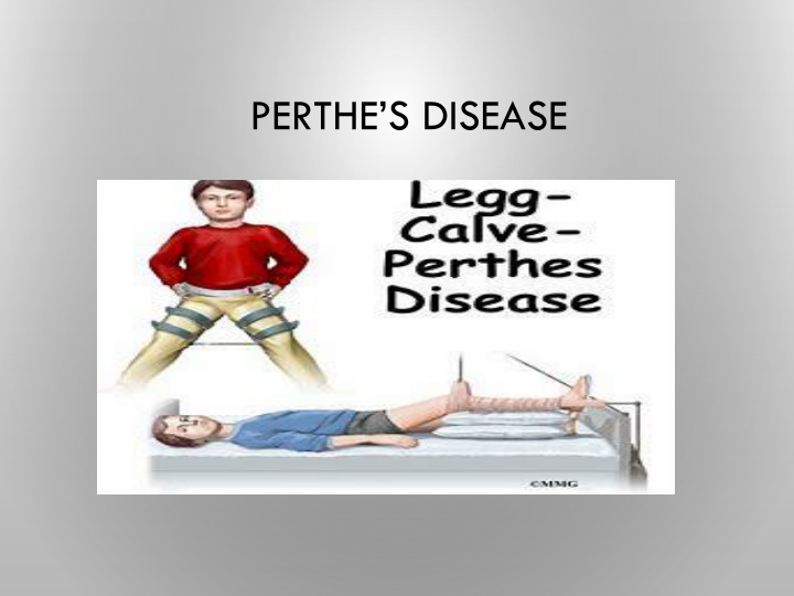 Perthes Disease in Pediatric Patients