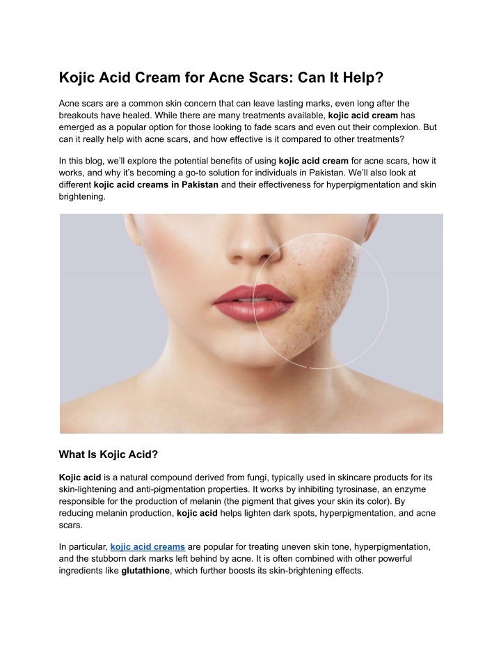 kojic acid cream for acne scars can it help n.w