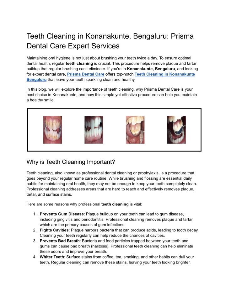 teeth cleaning in konanakunte bengaluru prisma n.w