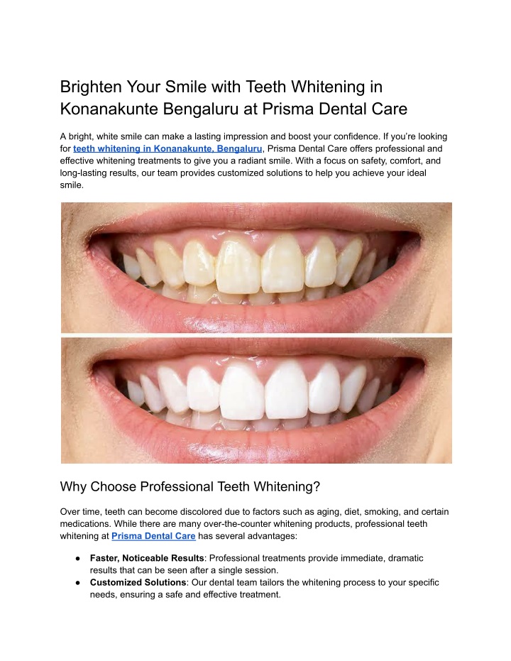 brighten your smile with teeth whitening n.w