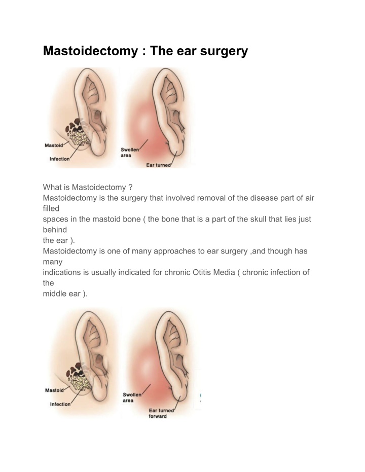 mastoidectomy the ear surgery n.w