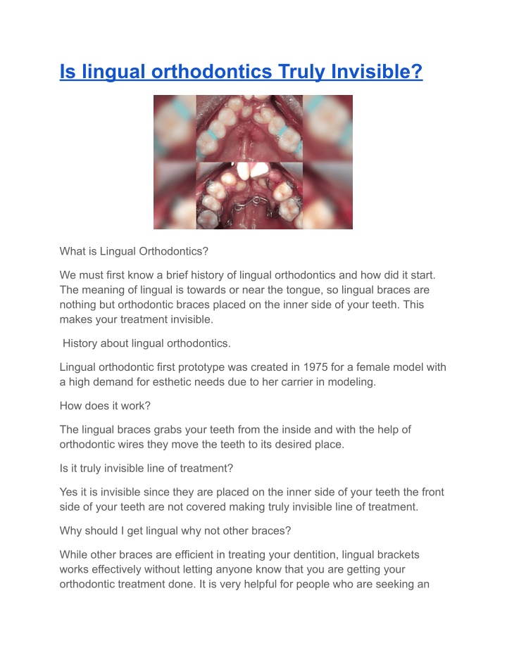 is lingual orthodontics truly invisible n.w