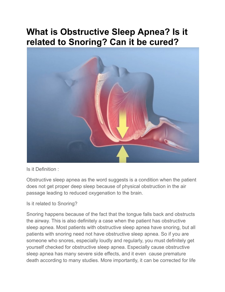 what is obstructive sleep apnea is it related n.w