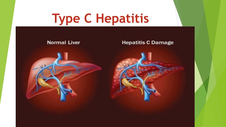 Type C Hepatitis