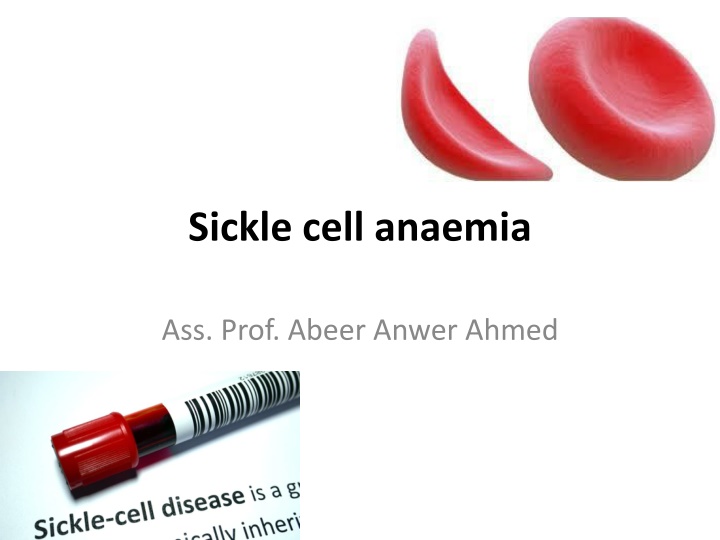 Sickle cell anaemia