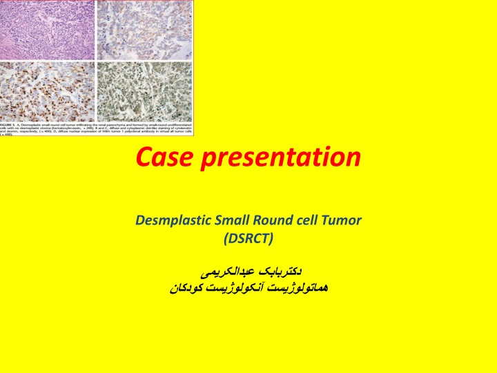Desmoplastic Small Round Cell Tumor (DSRCT) in a 5-Year-Old Boy: Case Presentation and Treatment Protocol