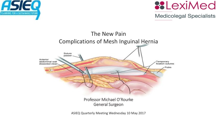 The New Pain  Complications of Mesh Inguinal Hernia