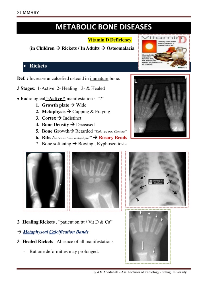 Summary of Metabolic Bone Diseases: Vitamin D Deficiency, Rickets, Osteomalacia