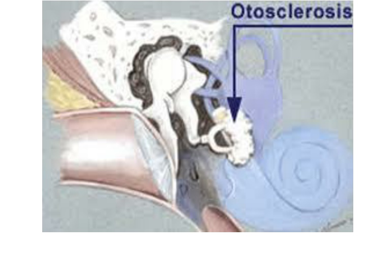 Otosclerosis in Adults: Causes and Symptoms
