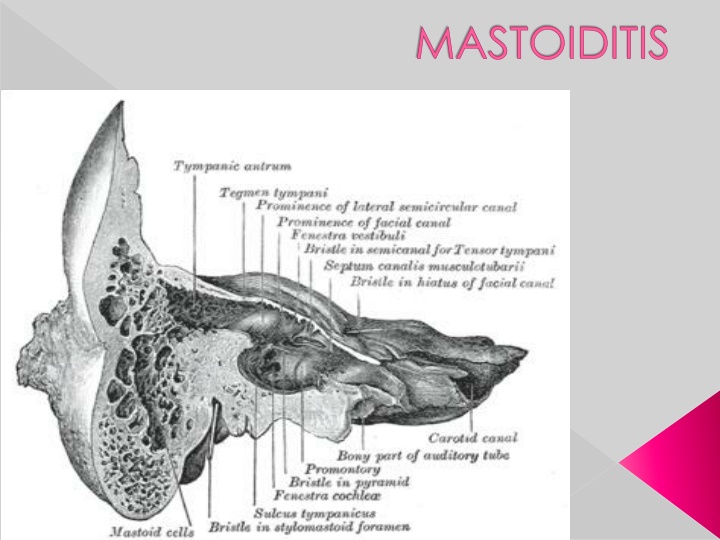 mastoiditis n.w