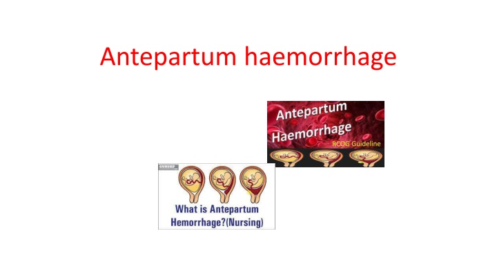 Antepartum haemorrhage