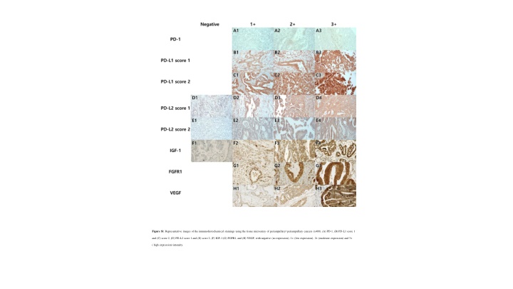 Immunohistochemical Stainings of Periampullary Cancers