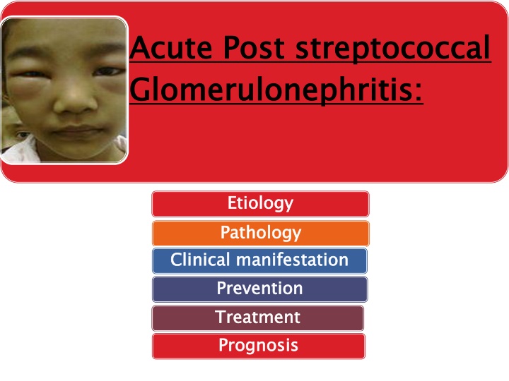 acute post streptococcal glomerulonephritis n.w