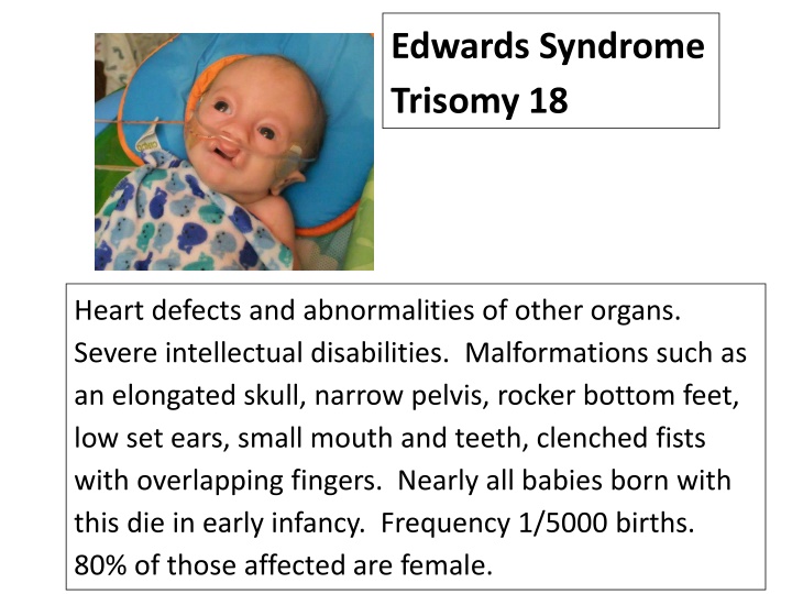 edwards syndrome trisomy 18 n.w