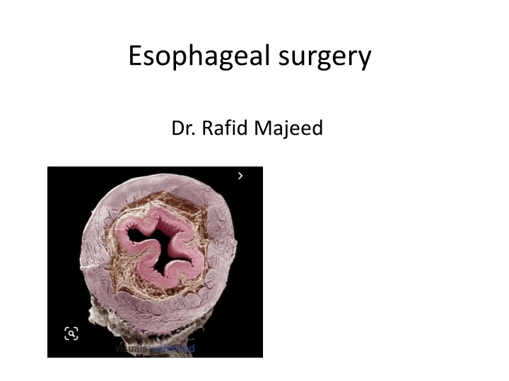 esophageal surgery n.w