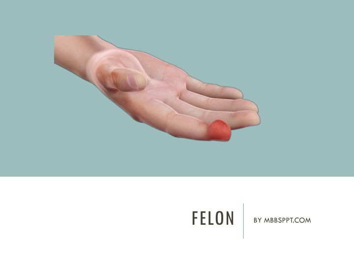 felon n.w