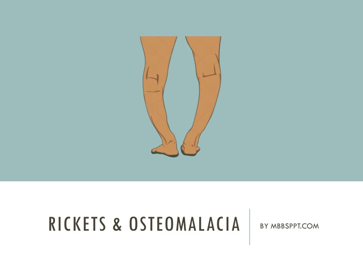 rickets osteomalacia n.w