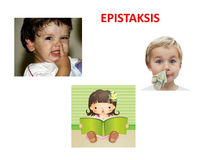 epistaksis n.w