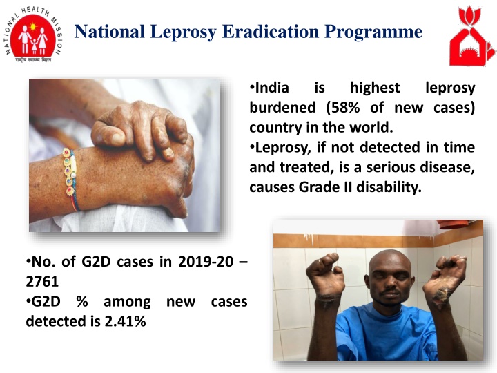 national leprosy eradication programme n.w
