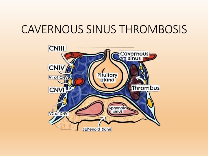 cavernous sinus thrombosis n.w