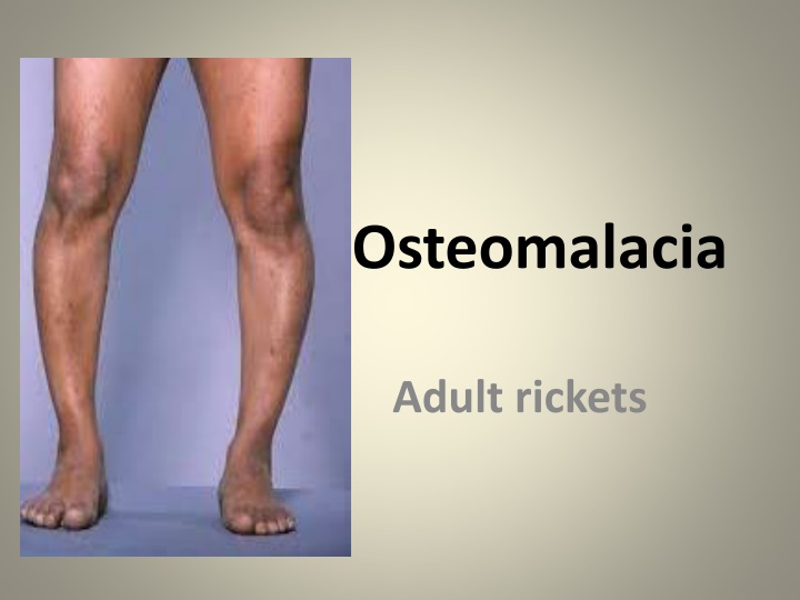 osteomalacia n.w
