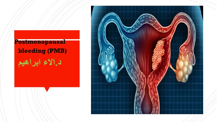 postmenopausal bleeding pmb n.w
