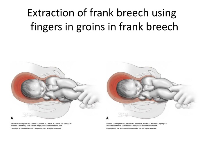 extraction of frank breech using fingers n.w