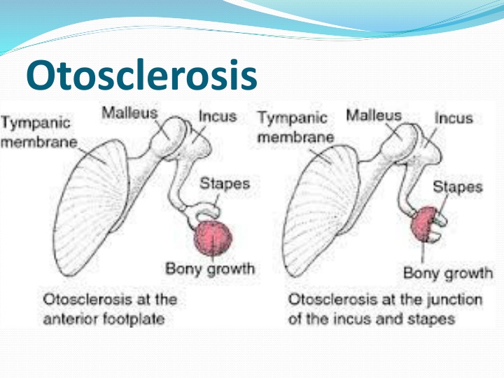 otosclerosis n.w
