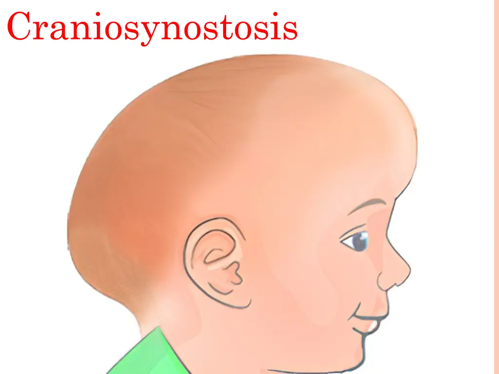 craniosynostosis n.w