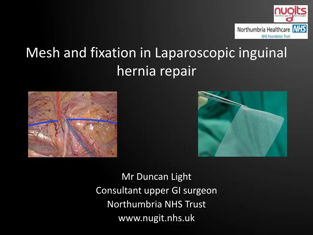 mesh and fixation in laparoscopic inguinal hernia n.w