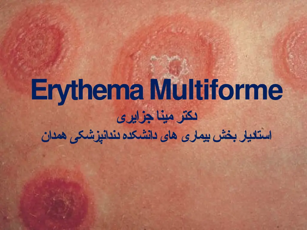 erythema multiforme n.w