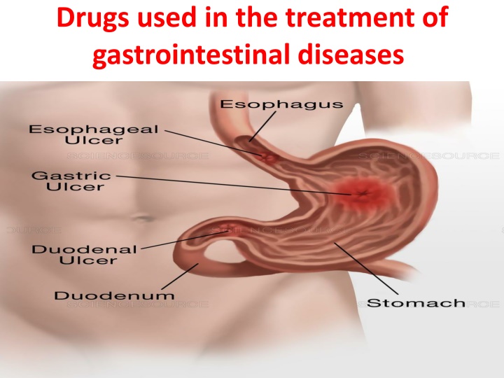 Peptic Ulcer Disease: Treatment Approaches and Helicobacter pylori Eradication