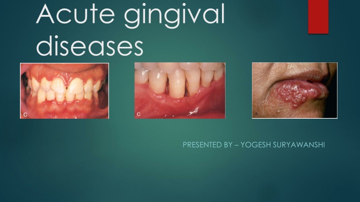 Overview of Acute Gingival Diseases