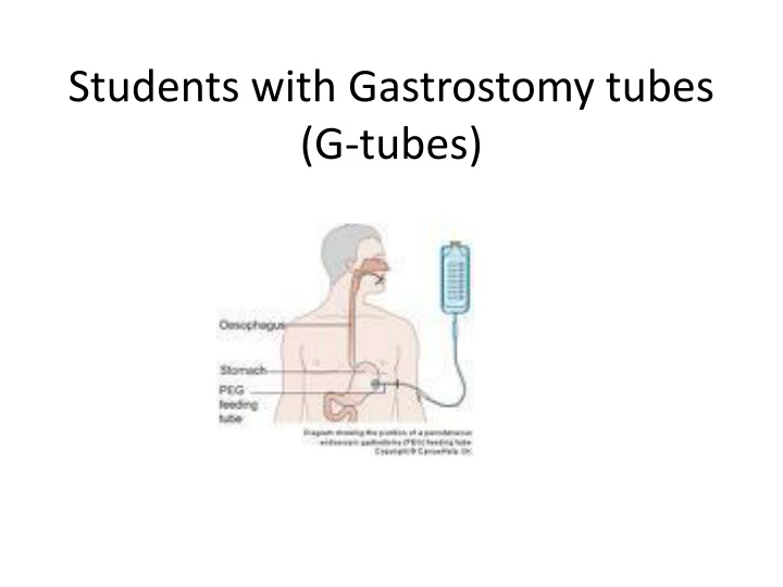 Gastrostomy Tubes (G-tubes) in Students