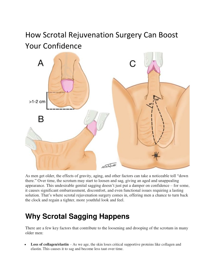 how scrotal rejuvenation surgery can boost your n.w